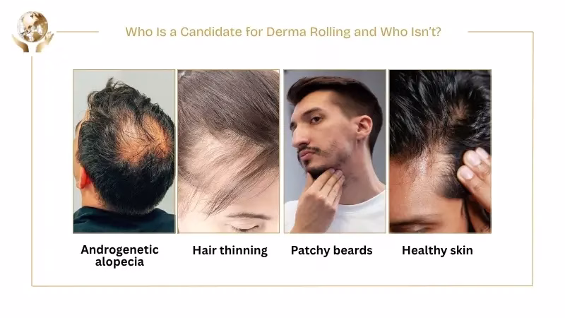 Informational infographic titled ‘Who Is a Candidate for Derma Rolling and Who Isn’t,’ visually comparing suitable and unsuitable candidates for derma rolling, with illustrated scalp and face icons indicating healthy individuals who may benefit from microneedling versus people with certain skin conditions or scalp issues who should avoid the treatment.