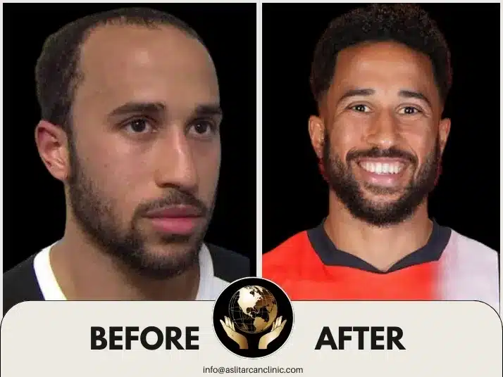 Before And After Transformation of Andros Townsend