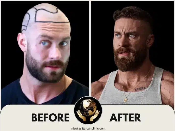 Before And After Transformation of Chris Bumstead