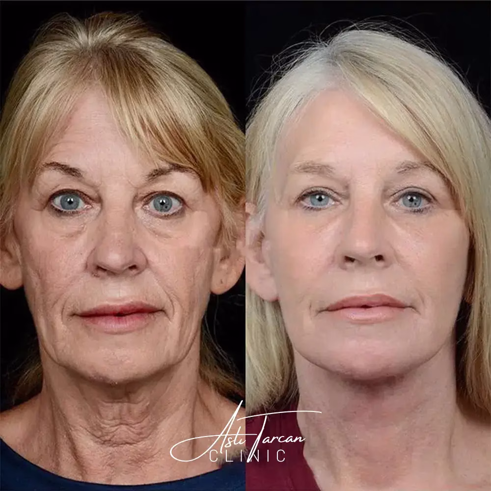 Vorher-nachher Bild einer Frau vor und nach einem Facelift mit sichtbar glatterer, strafferer Gesichtshaut.