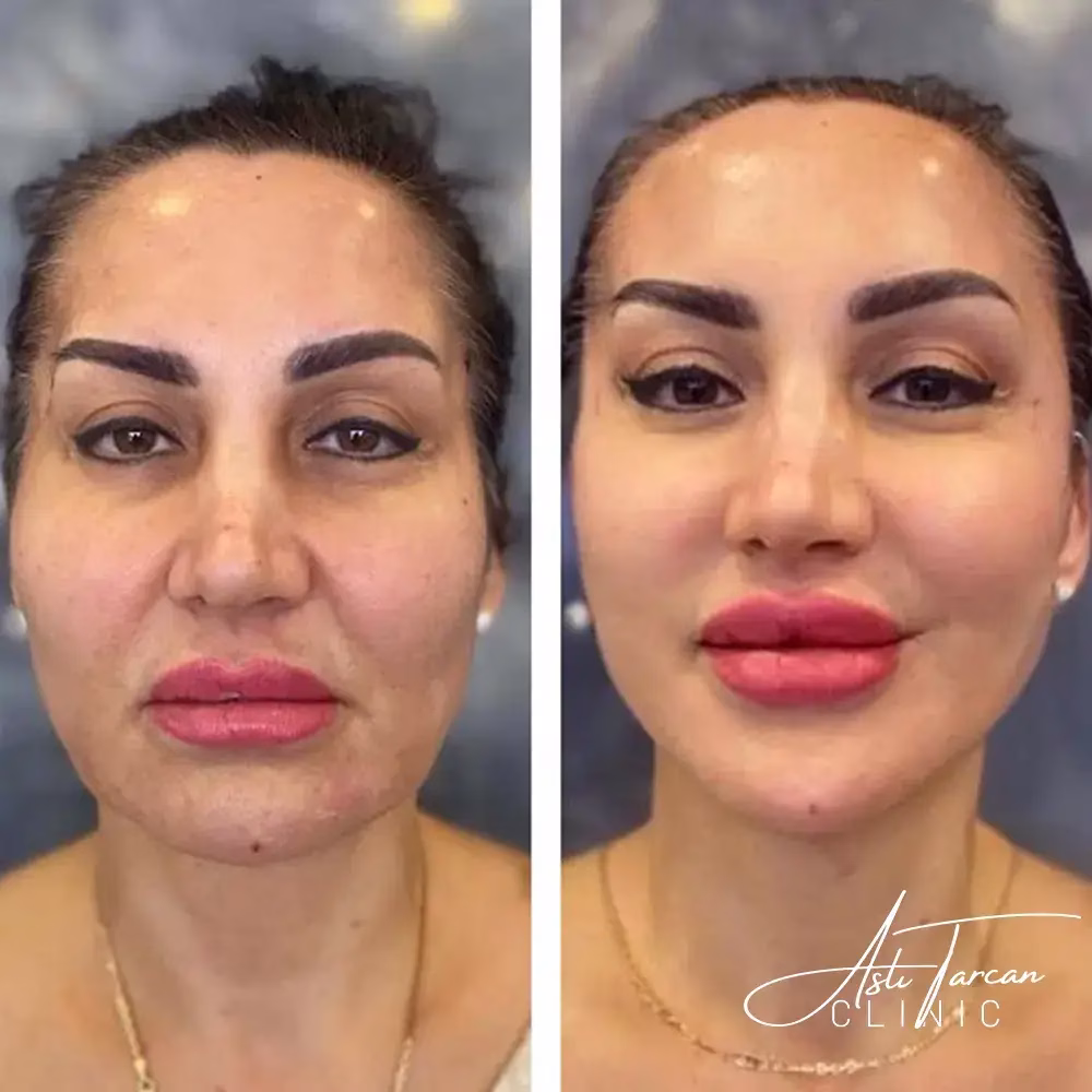 Vorher-nachher Bild einer Frau vor und nach einem Facelift mit sichtbar strafferen Gesichtszügen.