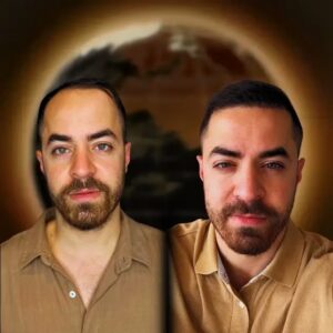 men-hair-transplant-before-and-after