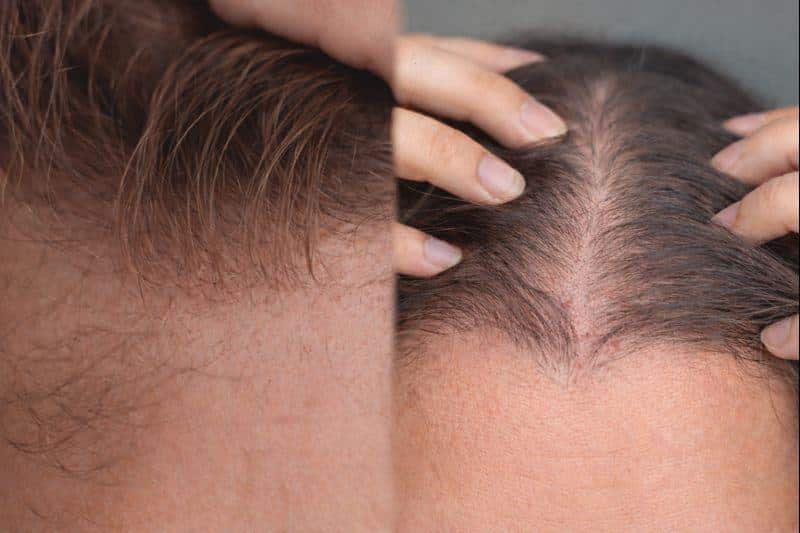 Zusammengesetztes Bild mit zwei Nahaufnahmen einer Kopfhaut: links ein zurückweichender Haaransatz mit dünner werdendem Haar, rechts ein gescheitelter Bereich mit sichtbar ausgedünntem Haar und freiliegender Kopfhaut, typisch für Androgenetische Alopezie, die mit den Händen zur Seite gehalten wird.