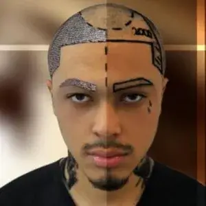 Vorschaubild für Augenbrauentransplantation