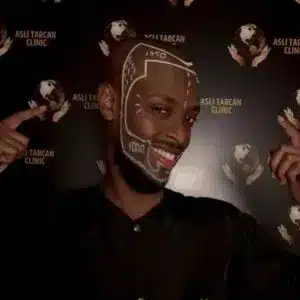 Vorschaubild für Barttransplantation