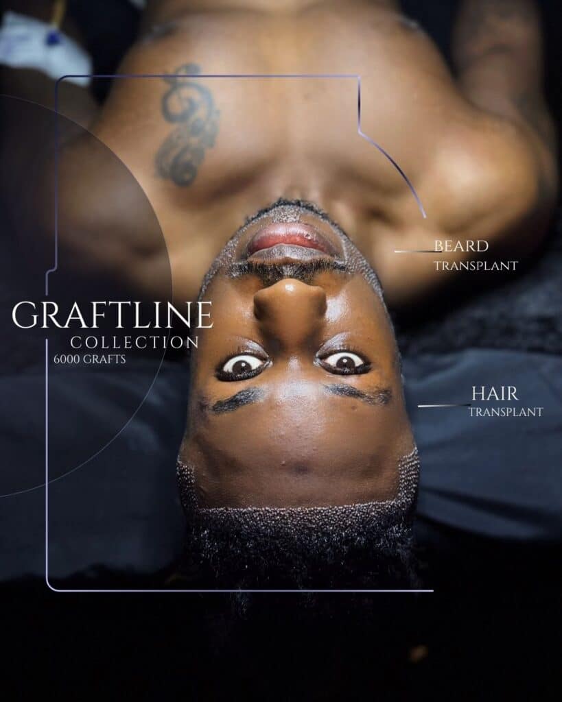 Patient lying down during a beard and hair transplant procedure in Turkey, with visible graft collection along the hairline and beard area, highlighting professional graftline collection and transplant treatment.