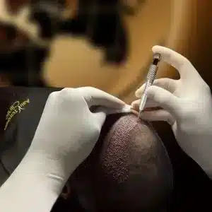 Vorschaubild für DHI Haartransplantation