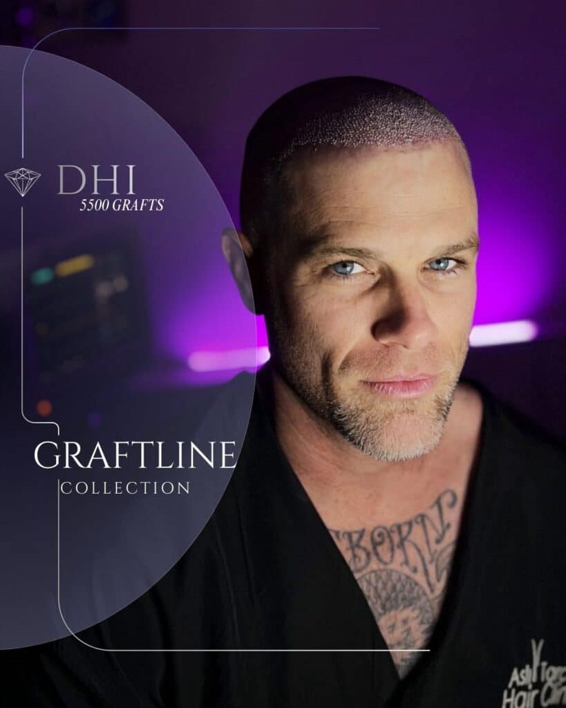Promotional image for DHI hair transplant showing a man after a DHI procedure with visible graft implantation on a closely shaved scalp, labeled “DHI 5500 grafts – Graftline Collection,” set against a purple studio background.