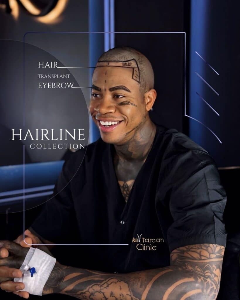 Smiling patient with a shaved head and pre-drawn surgical markings on the scalp and face, showing newly designed eyebrows as part of an eyebrow transplant in turkey at the Asli Tarcan Clinic.