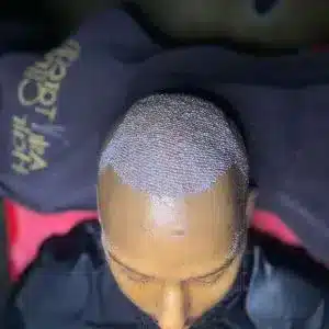 Vorschaubild für FUE Haartransplantation