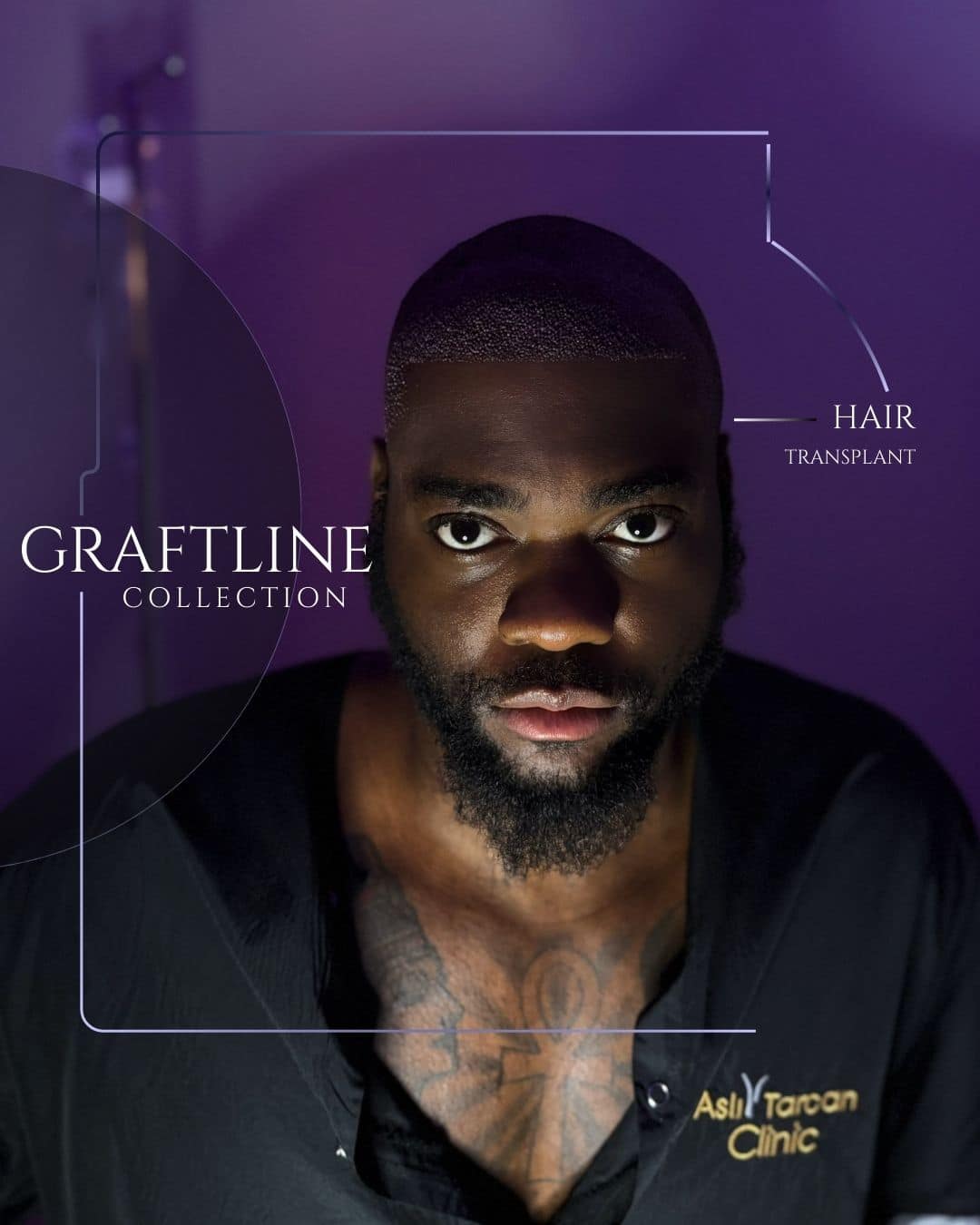 Portrait of a Black man after an FUE hair transplant in Turkey, showing a freshly defined hairline with visible graft placement, styled in a clinical setting with text reading ‘Graftline Collection’ and ‘Hair Transplant.