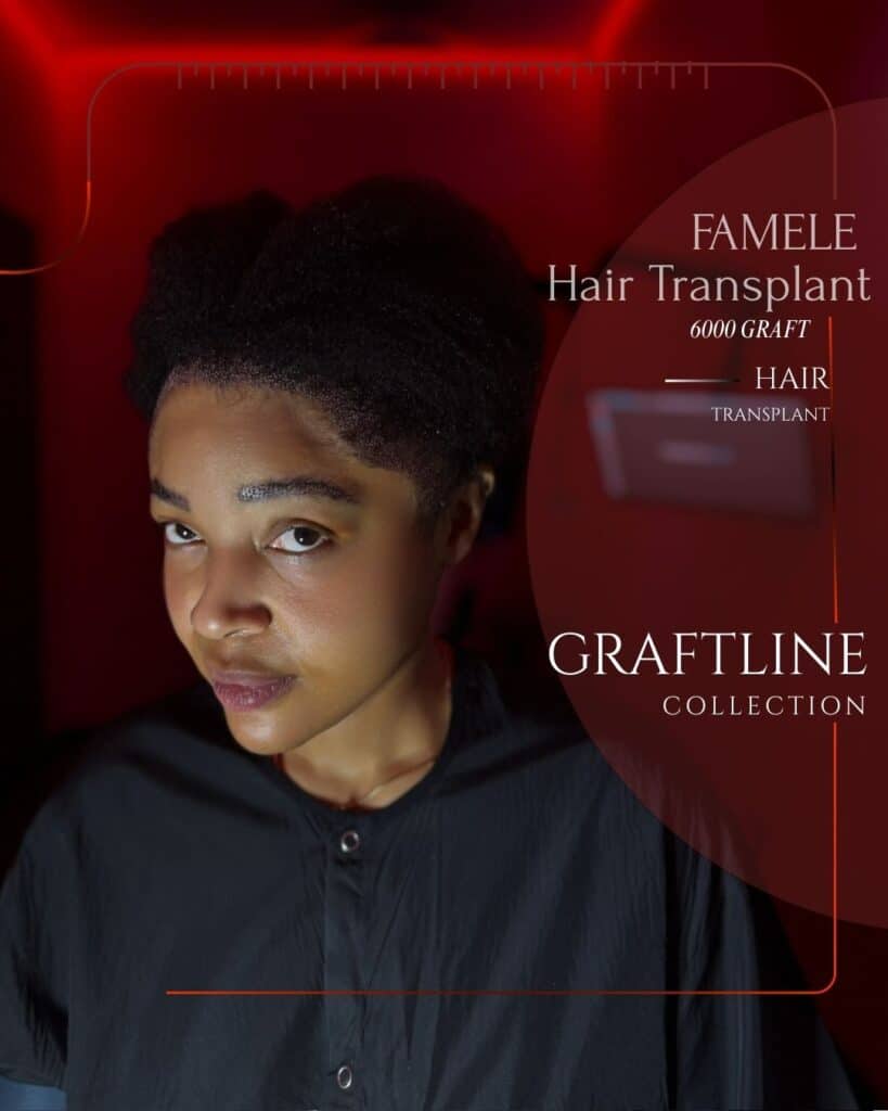 A woman with a newly restored, clearly defined graft line is shown against a dramatic red background. The image highlights precise graft placement and natural density at the hairline. Branding text reads “Female Hair Transplant – 6000 Graft” and “Graftline Collection,” emphasizing advanced technique, accuracy, and professional hair transplant results for women.