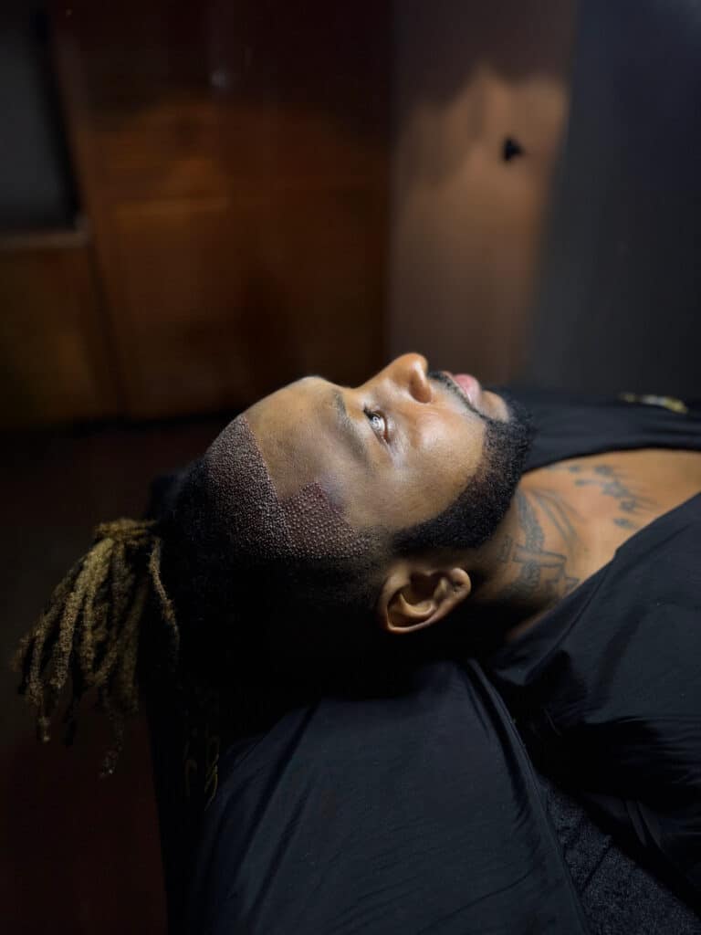 Close-up of a man lying back during or after a hair transplant procedure, showing a freshly transplanted hairline with visible grafts and long dreadlocks pulled back, highlighting the integration of the transplant with loc-style hair.