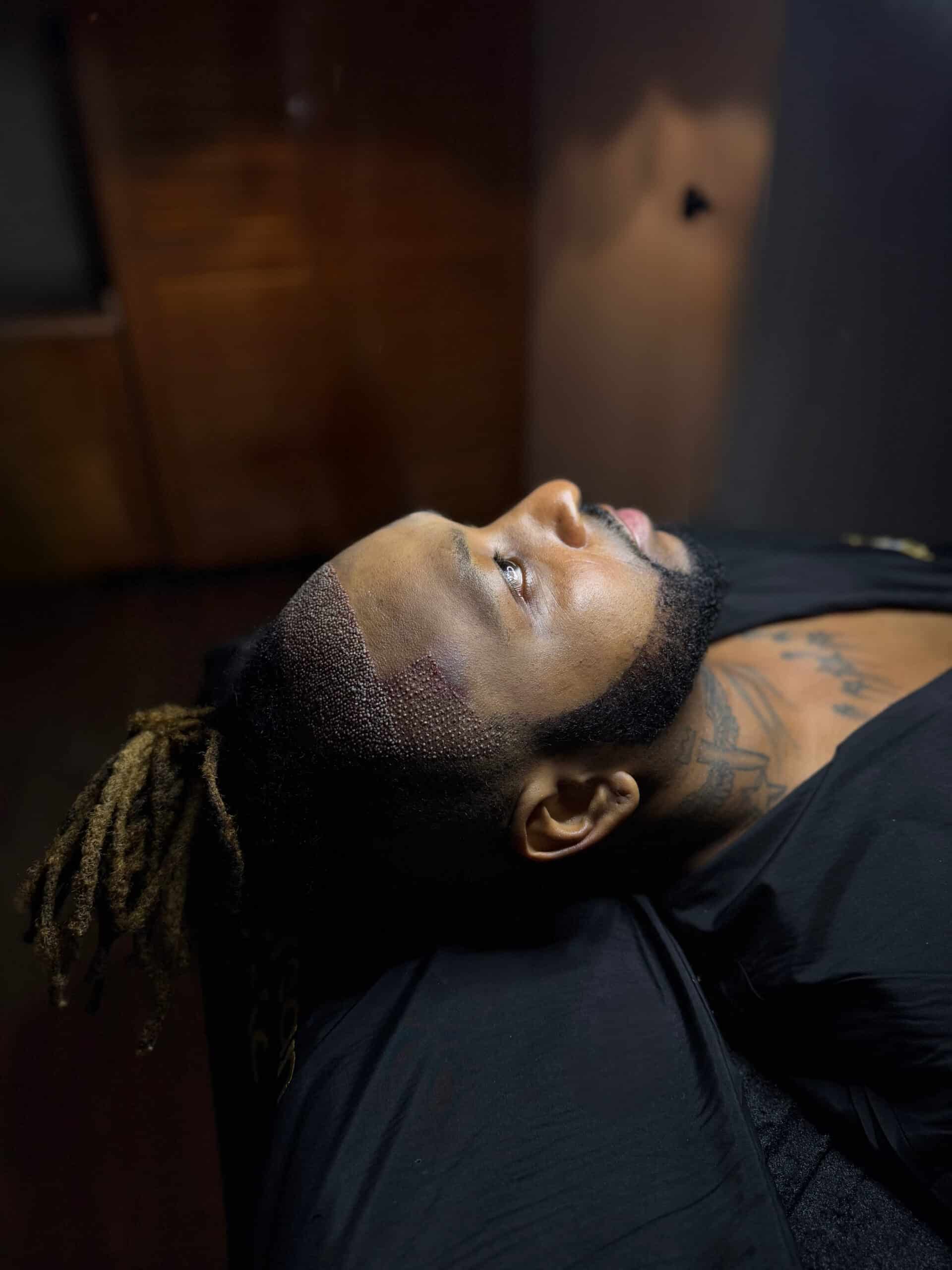 Close-up of a man lying back during or after a hair transplant procedure, showing a freshly transplanted hairline with visible grafts and long dreadlocks pulled back, highlighting the integration of the transplant with loc-style hair.