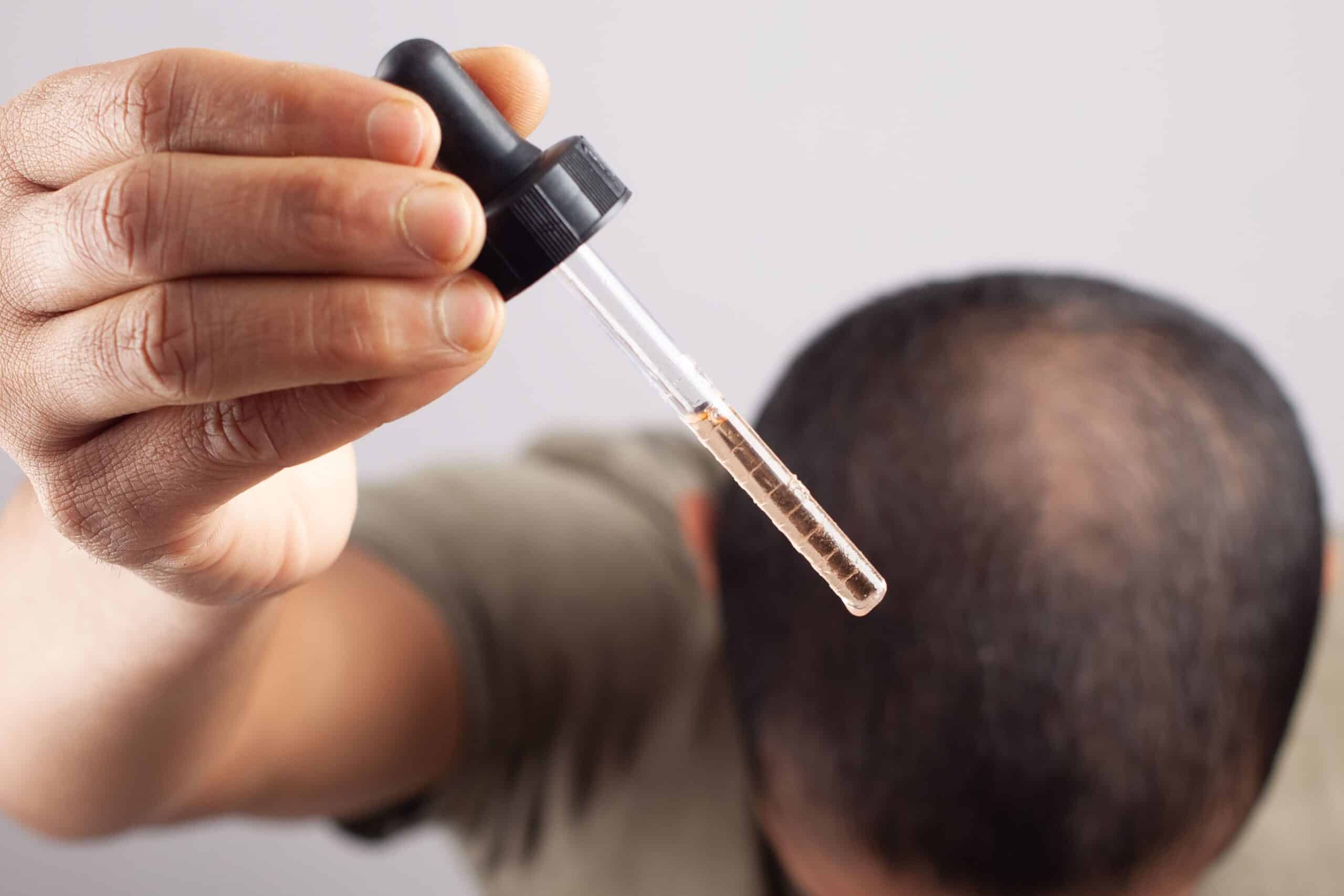 Applying minoxidil after hair transplant to support healing and promote healthy hair regrowth.