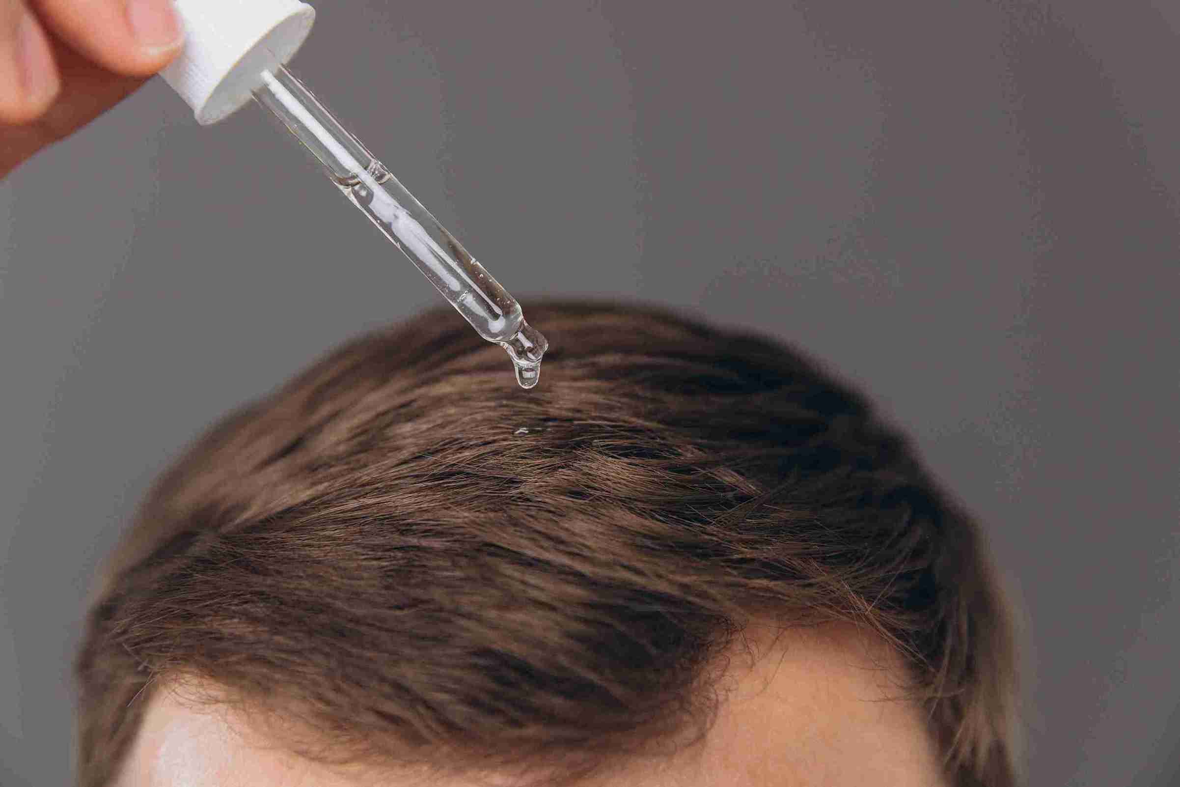Applying minoxidil to the scalp, with a dropper dispensing treatment onto newly transplanted hair follicles to support hair growth and recovery.
