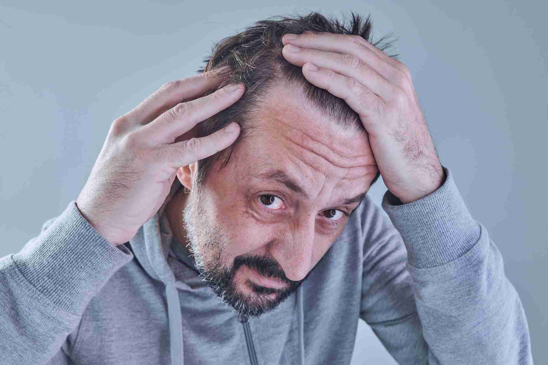A stressed middle-aged man holding his head and examining thinning hair in the mirror, illustrating the connection between Stress and Hair Loss and emotional anxiety.