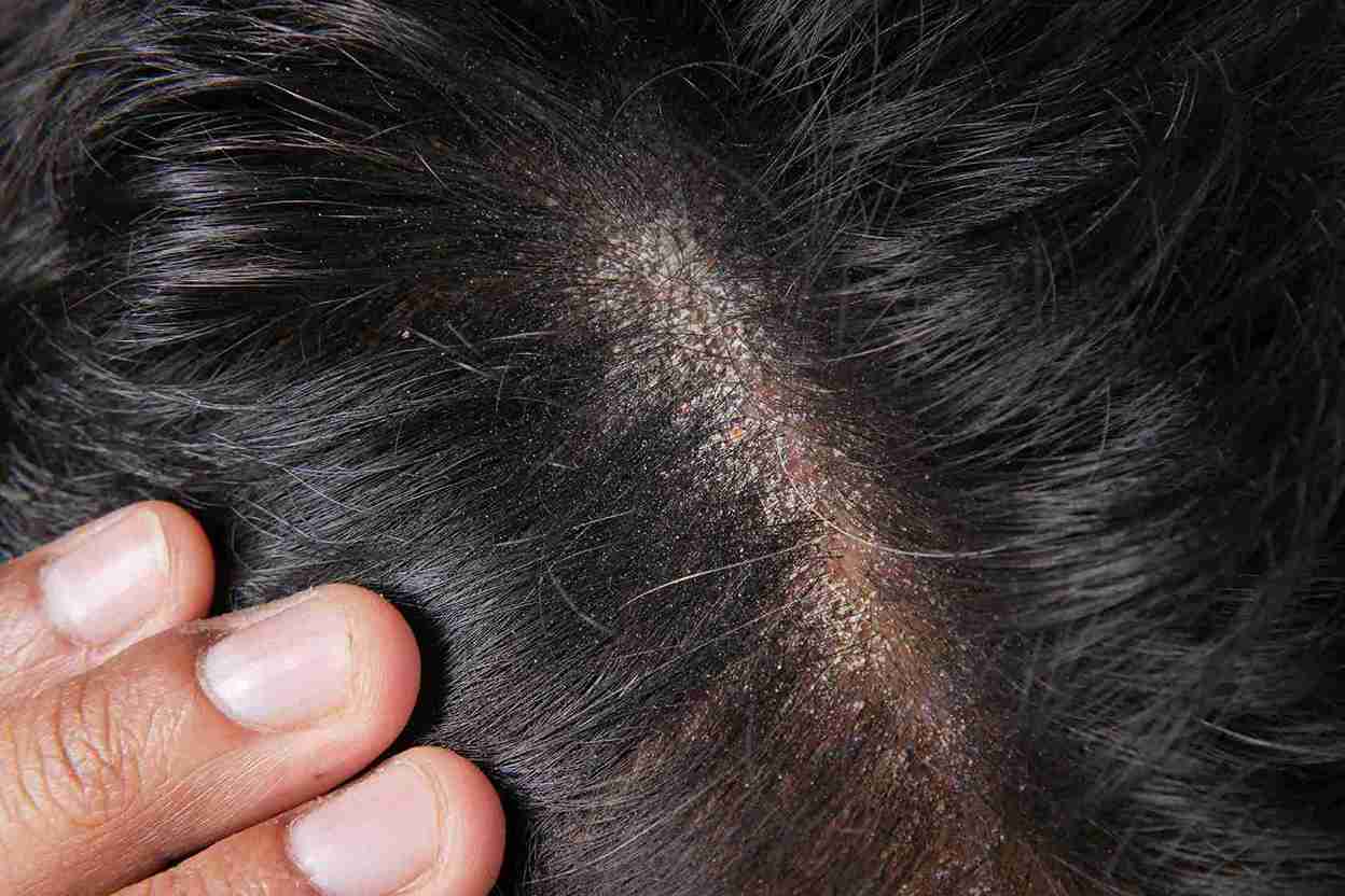 Primer plano del cuero cabelludo con zona visible de caída del cabello y enrojecimiento, representando Alopecia nerviosa.