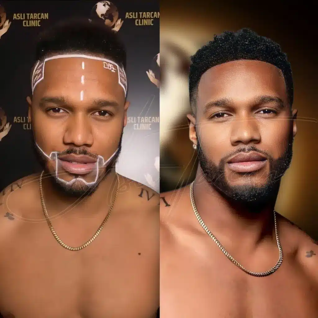 Before-After Hair Transplant - Levi