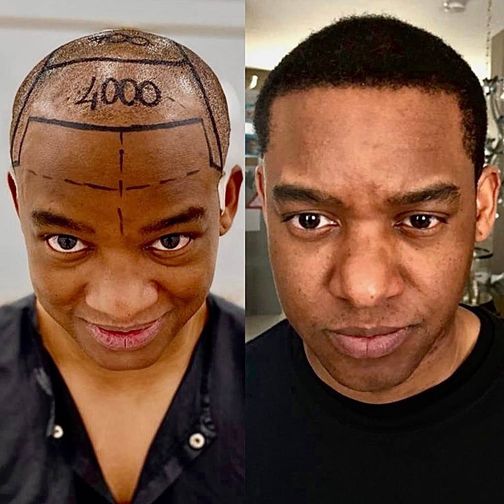 Before-After Hair Transplant - Liam