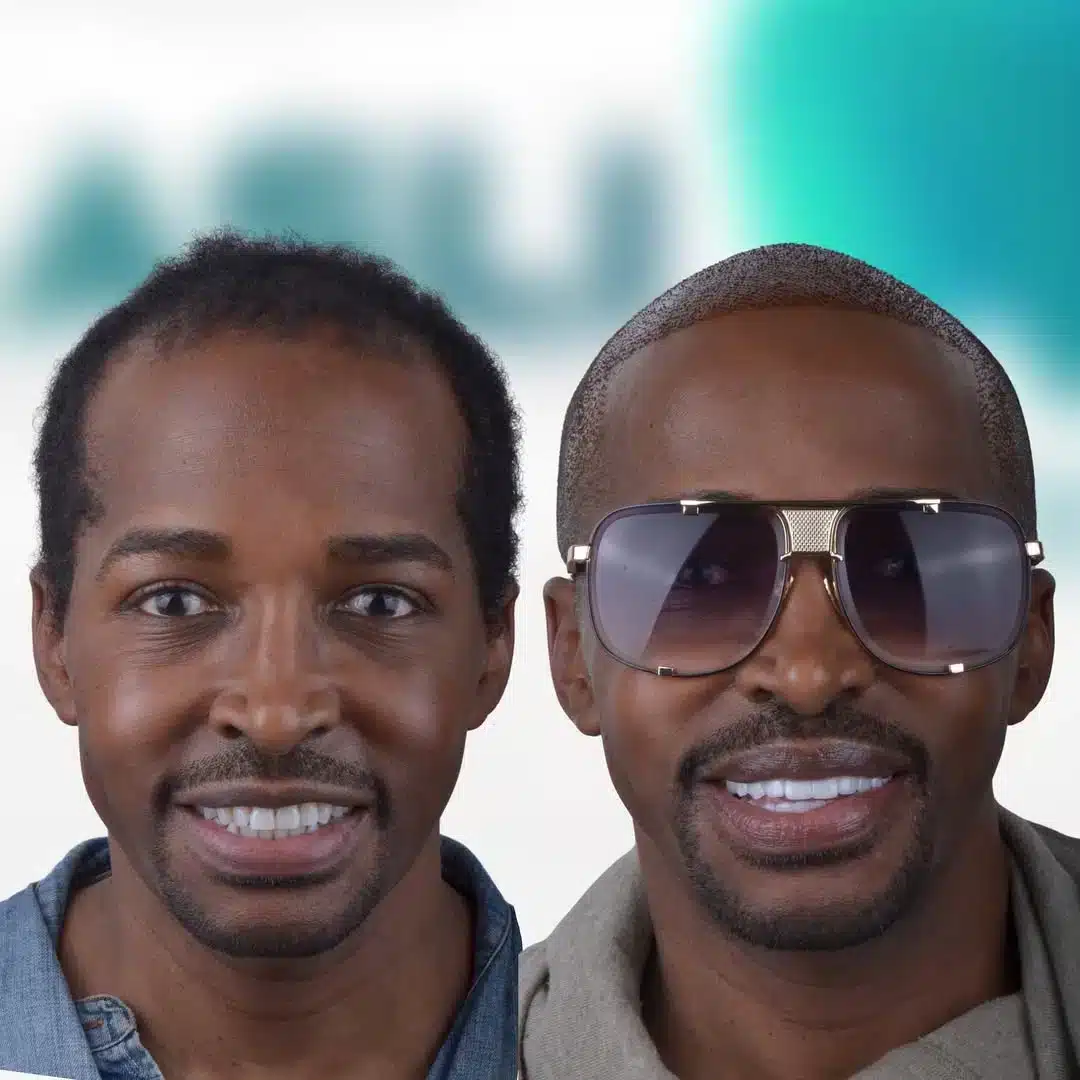 Vorher-Nachher-Ergebnis eines Zahnbleachings in der Türkei – lächelnder Mann mit sichtbar helleren, weißeren Zähnen nach der Behandlung.