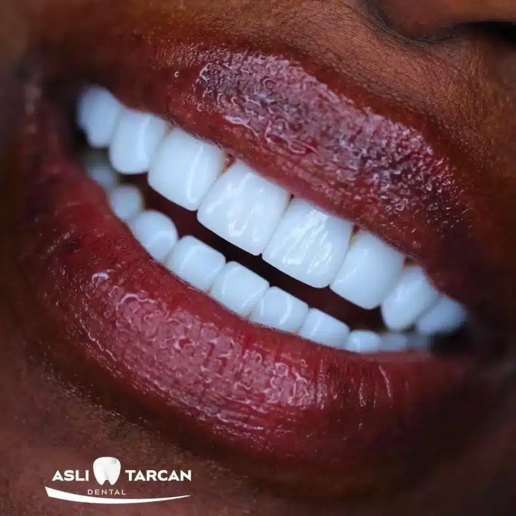 Nahaufnahme eines strahlenden Lächelns mit sehr weißen Zähnen nach professioneller Zahnaufhellung, ästhetisches Ergebnis.