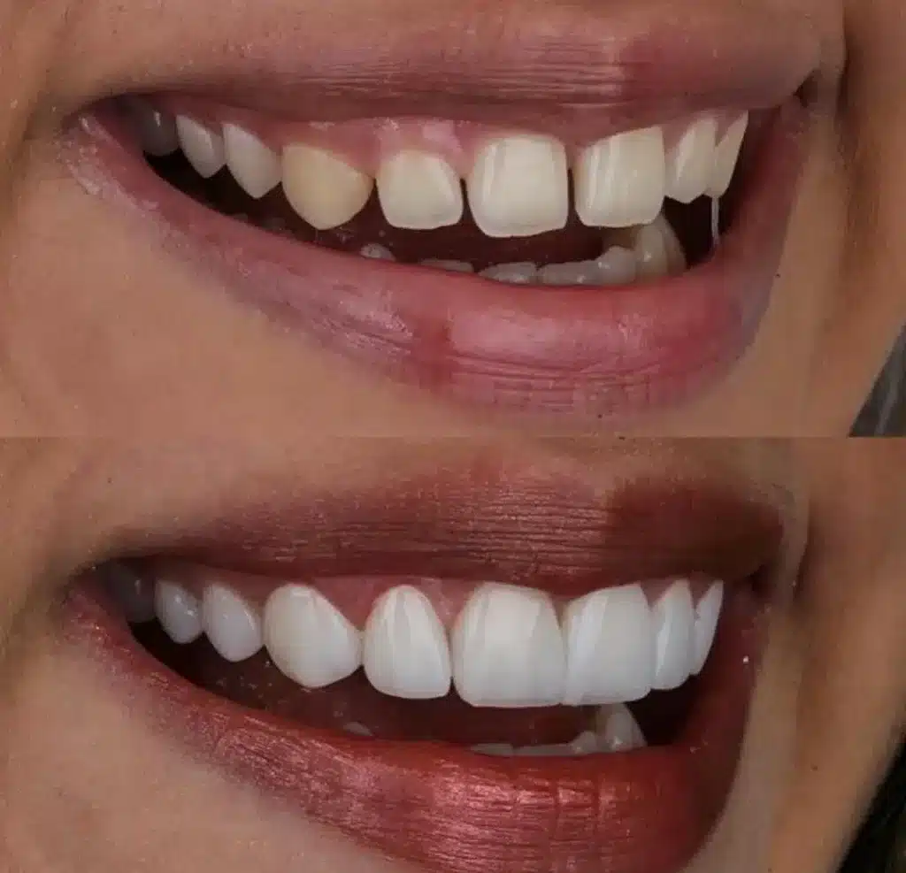 Vorher-Nachher-Vergleich eines Lächelns nach Zahnaufhellung mit deutlich weißeren Zähnen, sichtbare ästhetische Verbesserung.