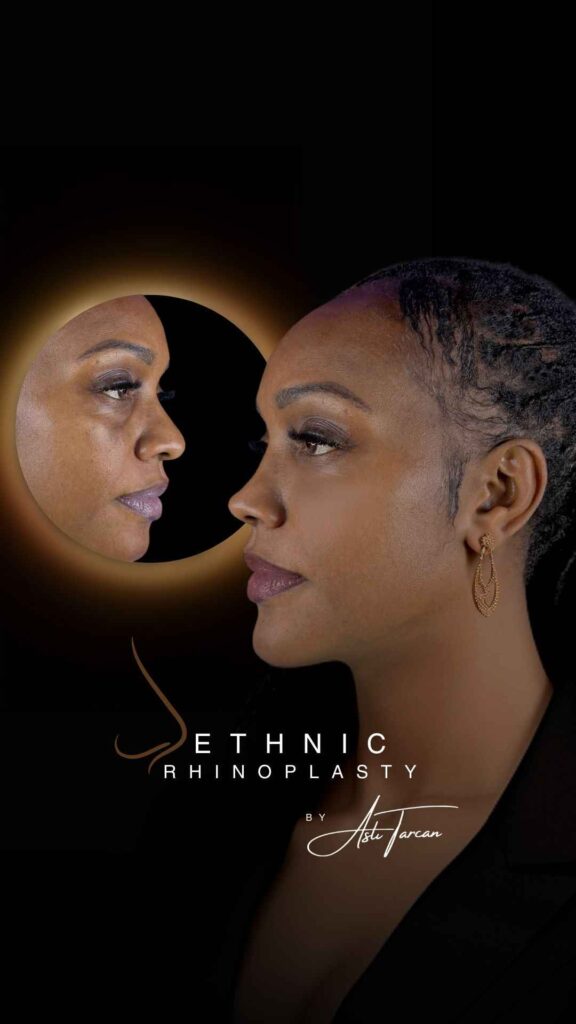 Image showing example of Ethnic Rhinoplasty