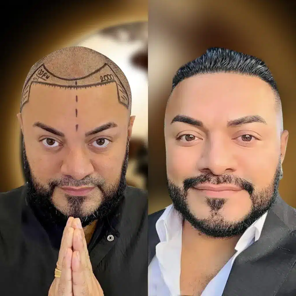 Vorher-Nachher Haartransplantation - Milan