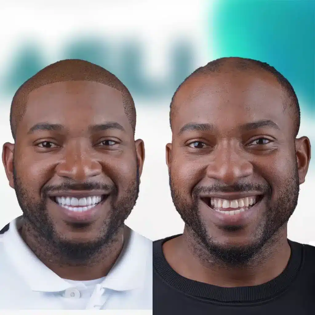 Vorher-Nachher-Vergleich eines Patienten mit ästhetischer Zahnbehandlung, sichtbare Verbesserung des Lächelns – Zahnimplantat Türkei Ergebnis.