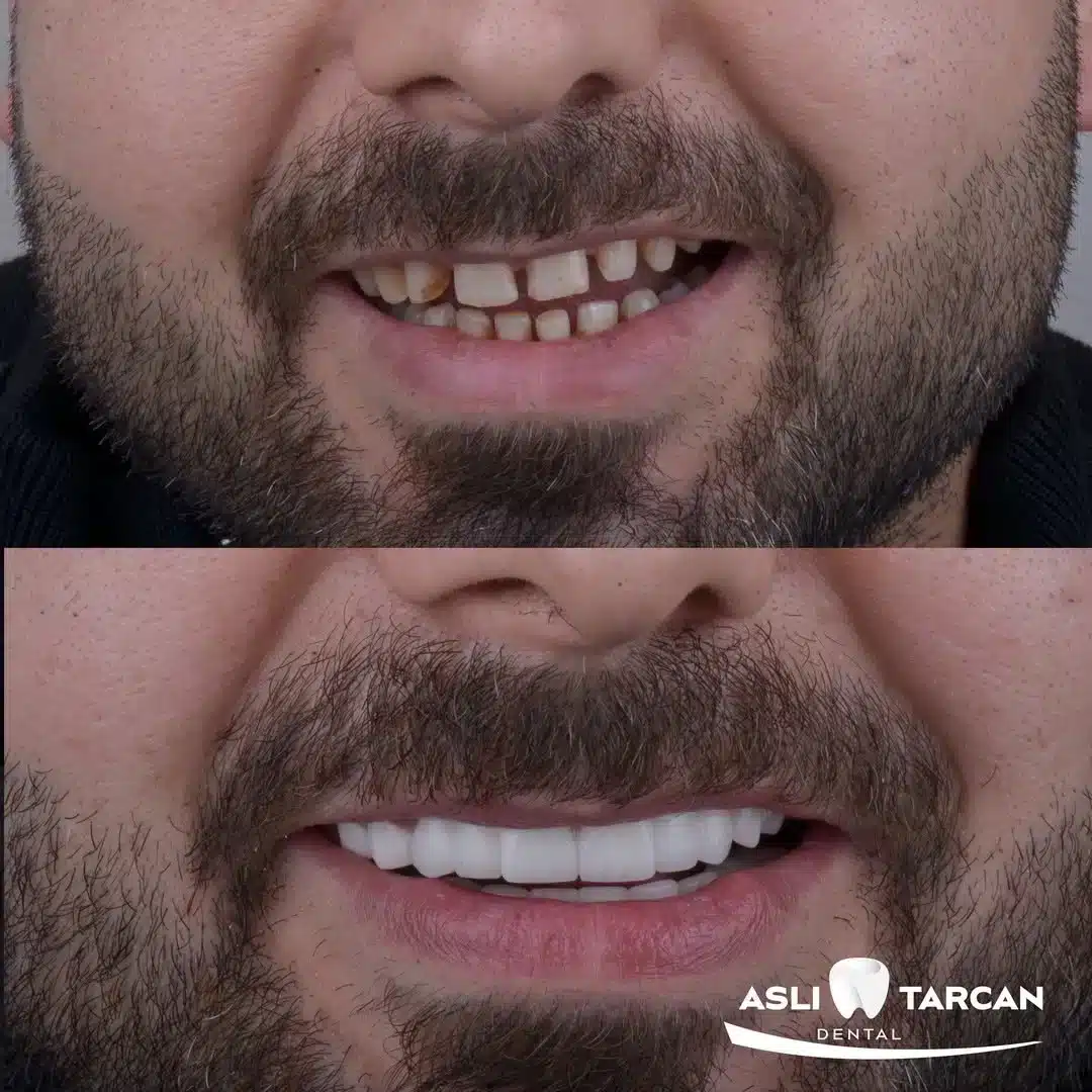 Vorher-nachher-Vergleich eines Männerlächelns: Oben ungleichmäßige, verfärbte und lückenhafte Zähne, unten gerade, helle und gleichmäßige Zähne nach einer Zahnbehandlung; Nahaufnahme von Mund und Bart, unten mit Logo einer Zahnklinik.