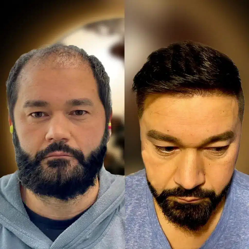 vorher-nachher Haartransplantation - Elias