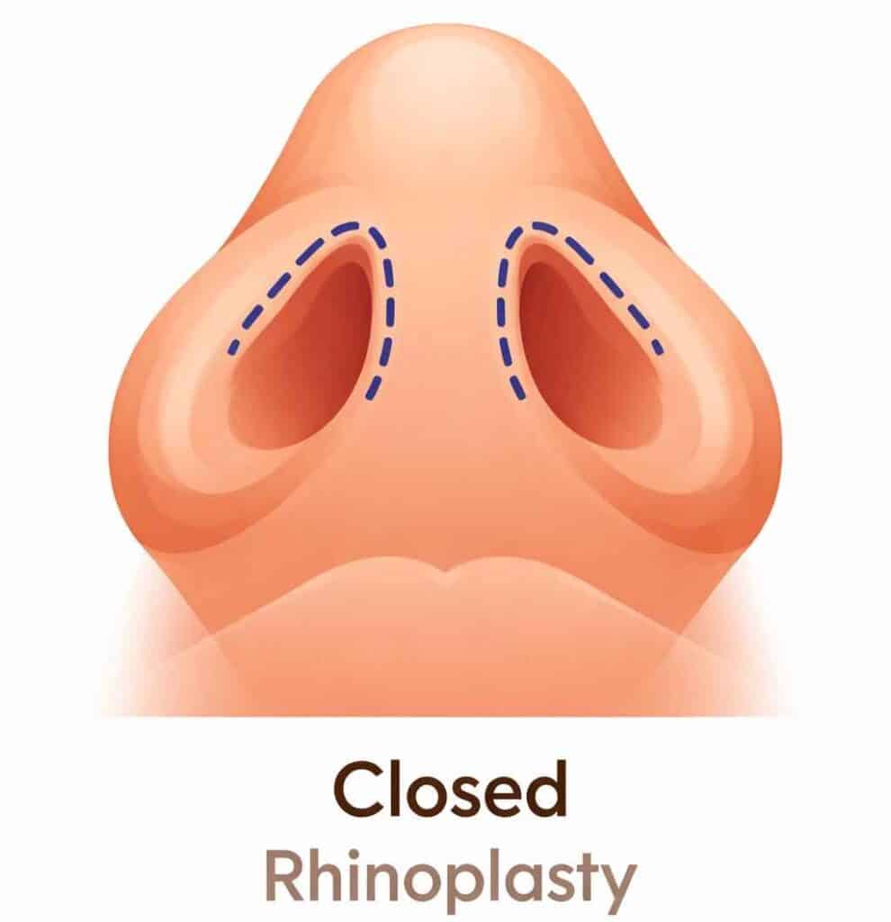 Image showing Closed Rhinoplasty Technique