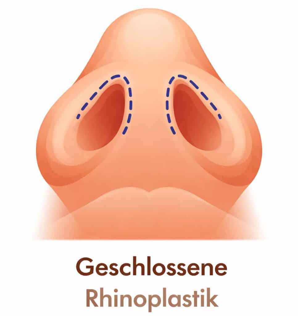 Bild welches die Schnitte bei einer geschlossenen Rhinoplastik zeigt