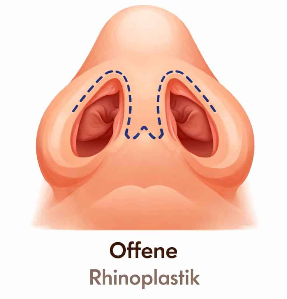 Bild welches die Schnitte bei einer offenen Rhinoplastik zeigt