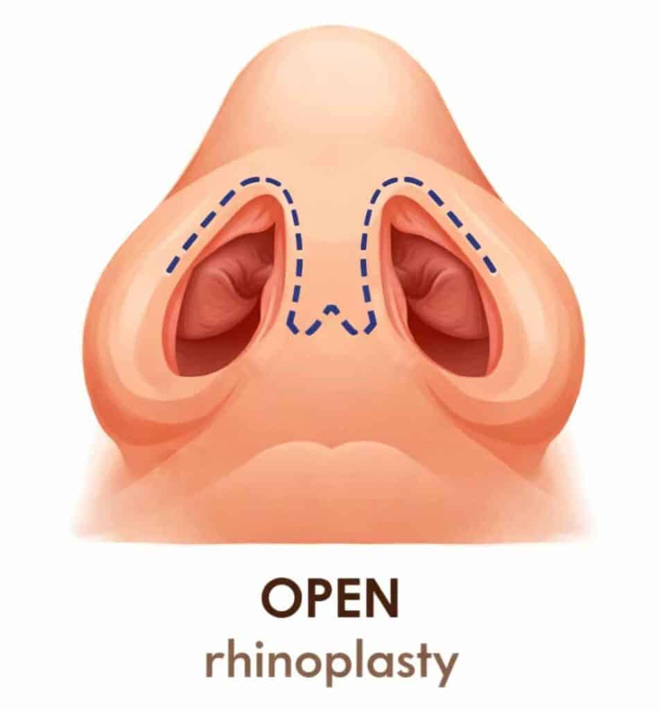 Image showing Open Rhinoplasty Technique