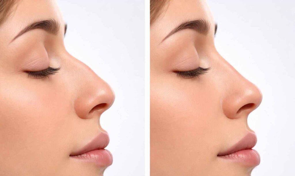 Bild, das eine Simulation einer Rhinoplastik zeigt.