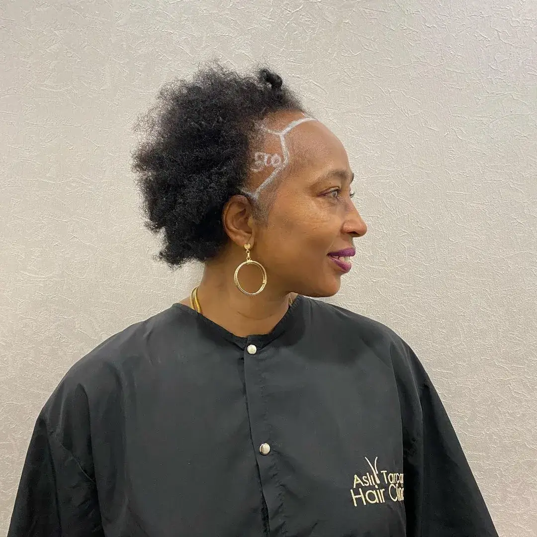 11 female hair transplant before