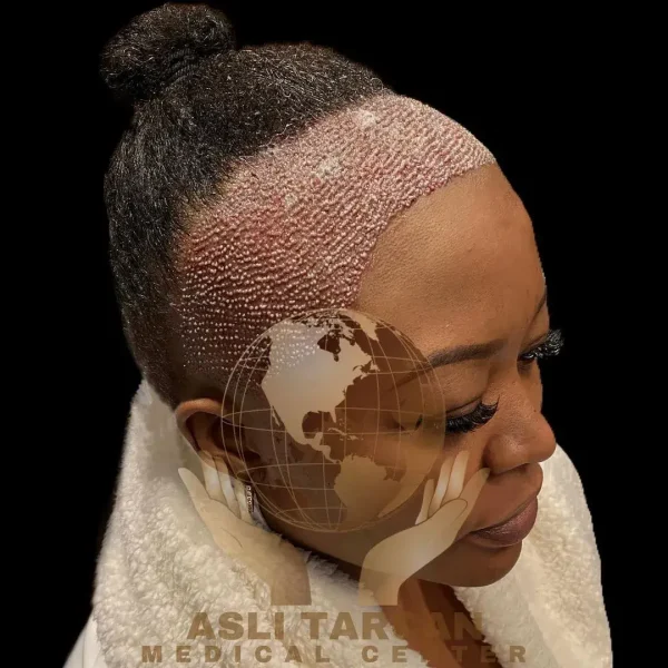 afro hair transplant,Afro Hair Transplant turkey,afro hair transplant in Turkey