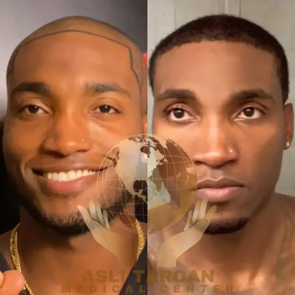 afro hair transplant,Afro Hair Transplant turkey,afro hair transplant in Turkey