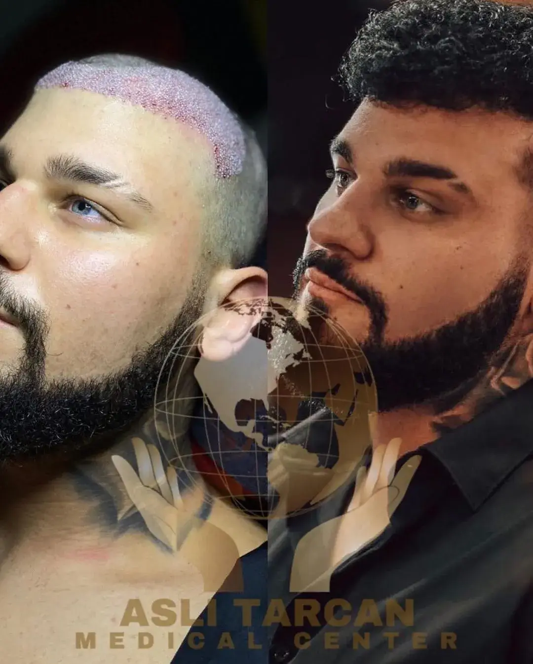 Forehead reduction surgery with hair transplant before and after