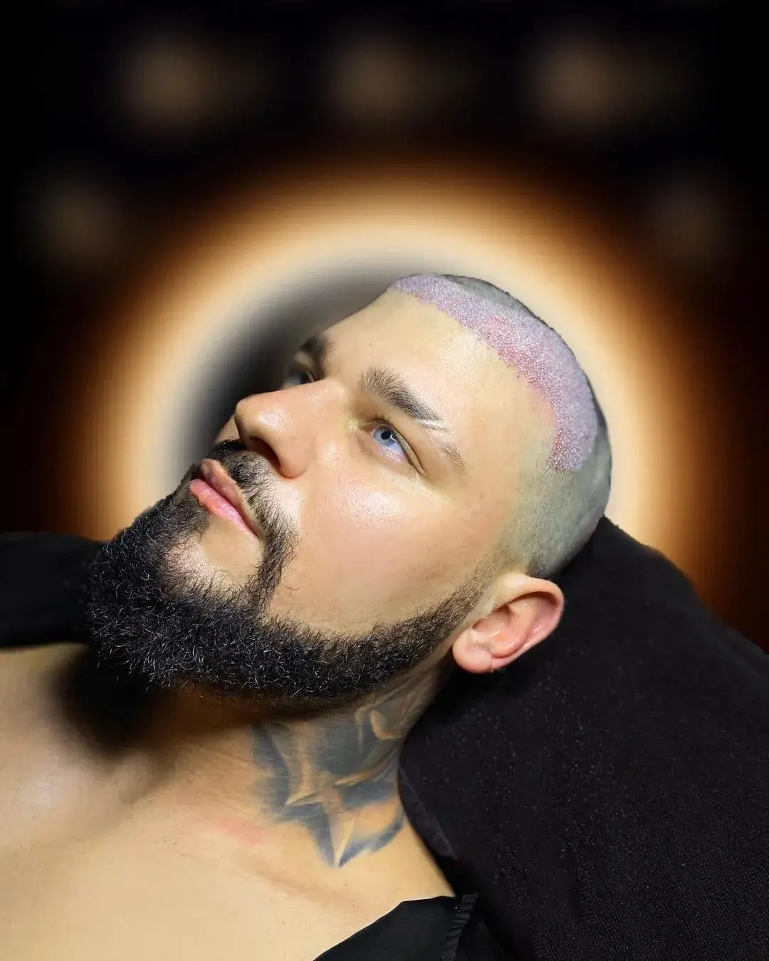 after forehead reduction surgery