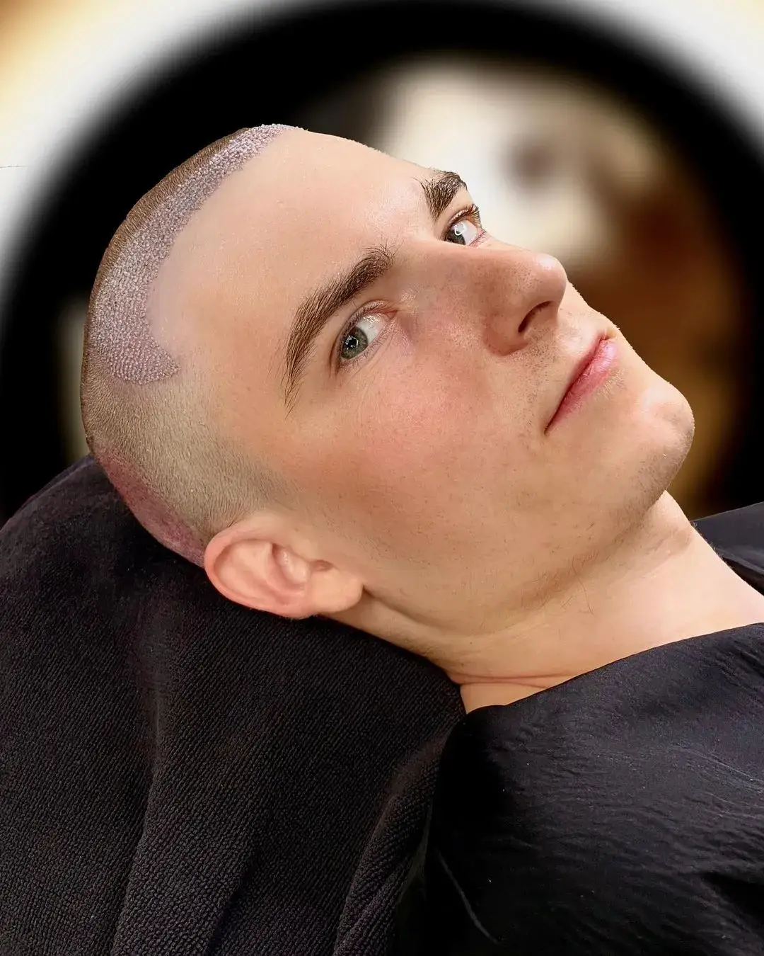 immediate after hairline surgery