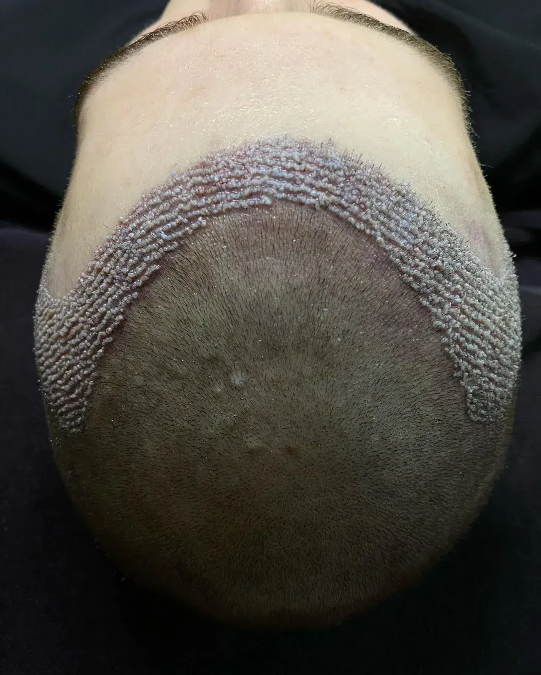 forehead restoration surgery in turkey