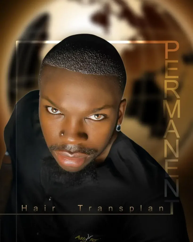 İmmediate post Afro Hair Transplant in Turkey