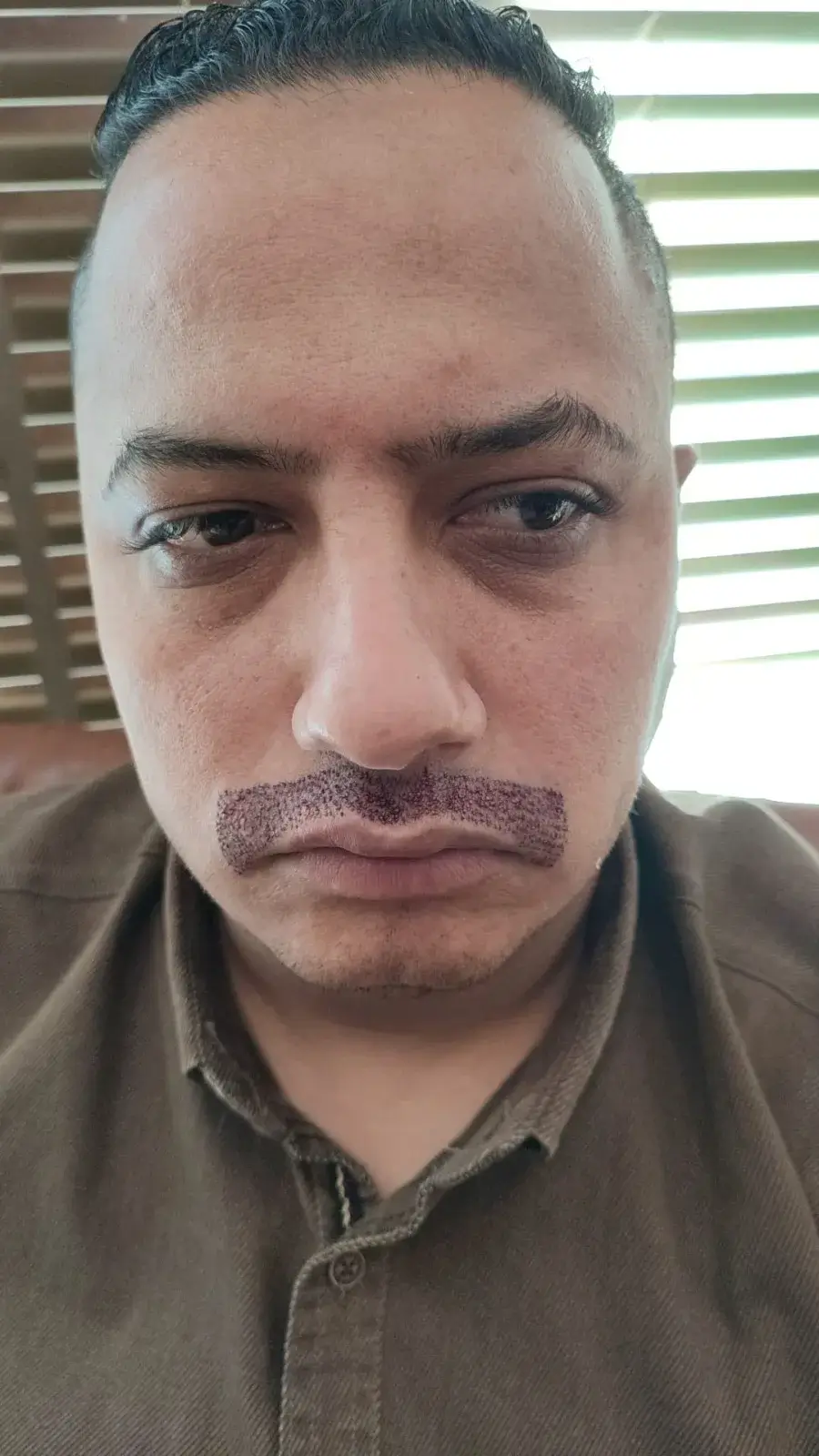 4 After Mustache Transplant