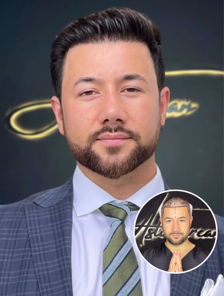 76 Advantages Of Hair Transplant Turkey