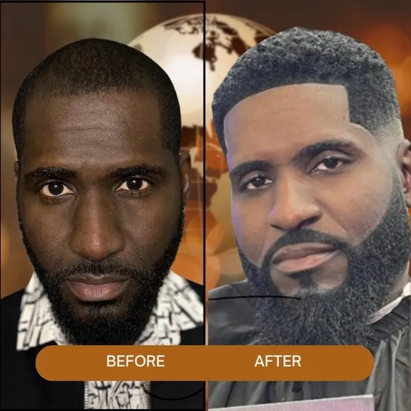 afro hair transplant,Afro Hair Transplant turkey,afro hair transplant in Turkey