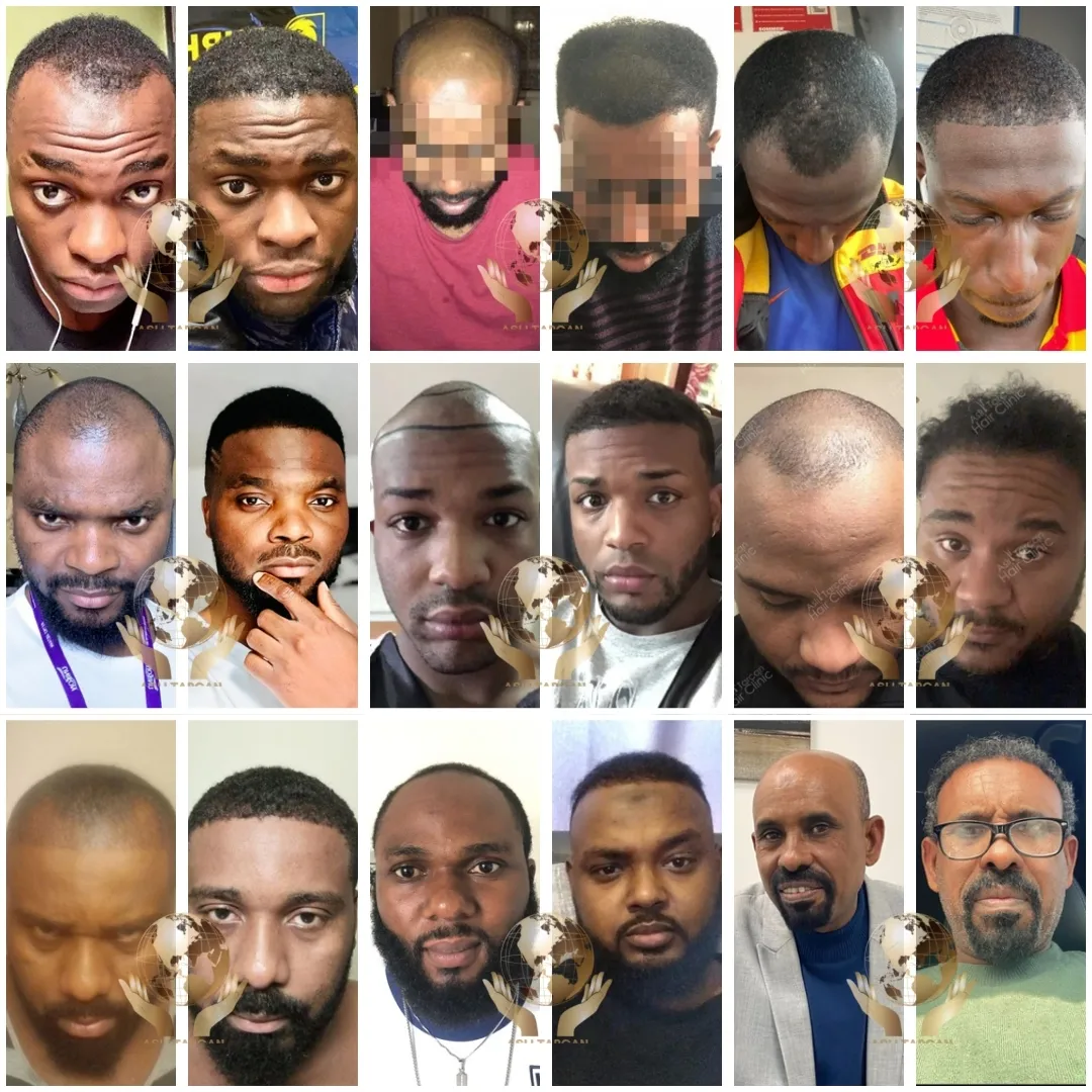 afro hair transplant,Afro Hair Transplant turkey,afro hair transplant in Turkey