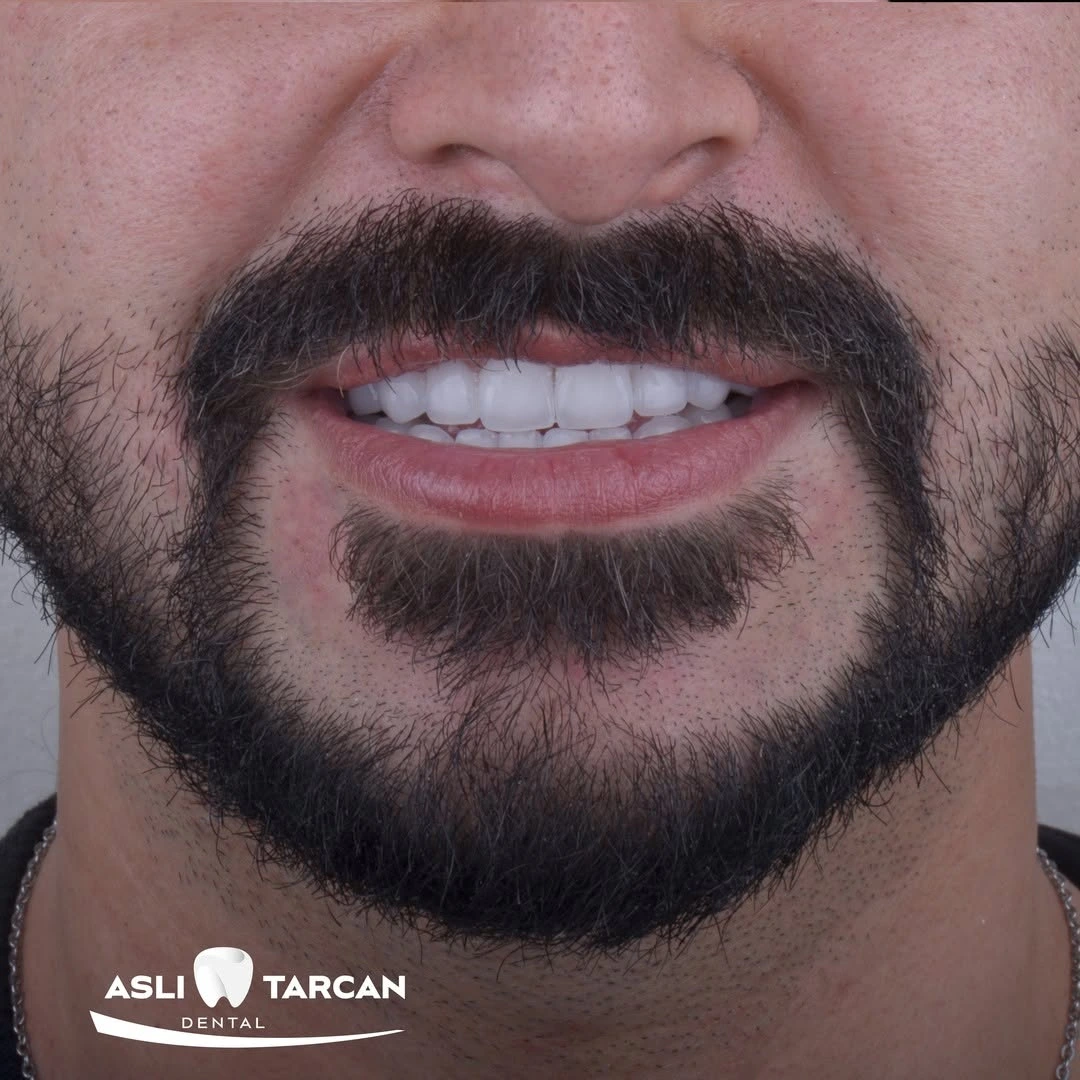 Zirconium Crowns Turkey 9 Am I The Right Candidate For Zirconium Crown Turkey